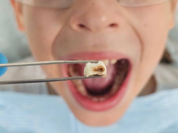 Best Emergency Dental Extractions in Walnut Creek, NC